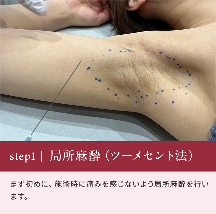 step1 局所麻酔（ツーメセント法） まず初めに、施術時に痛みを感じないよう局所麻酔を行います。 
