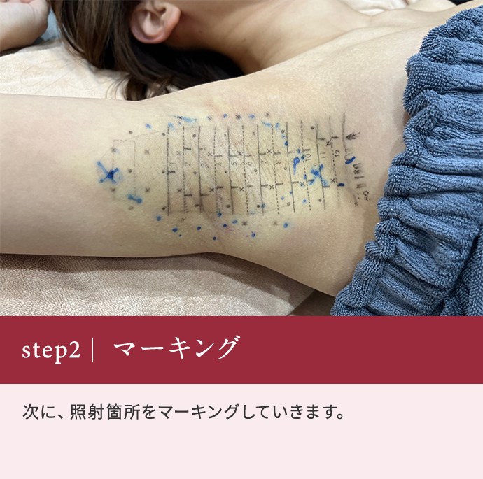 step2 マーキング 次に、照射箇所をマーキングしていきます。