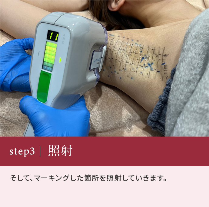 step3 そして、マーキングした箇所を照射していきます。